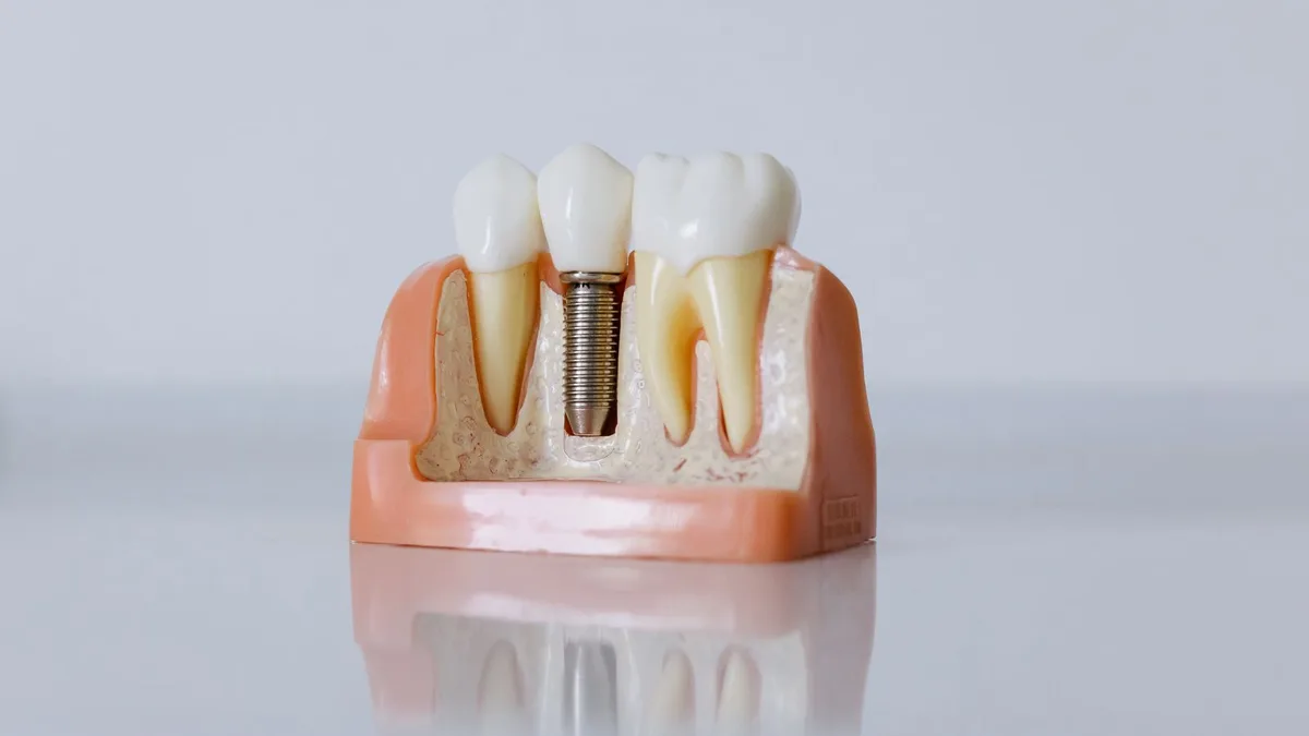 Modèle pédagogique montrant un implant dentaire entre deux dents