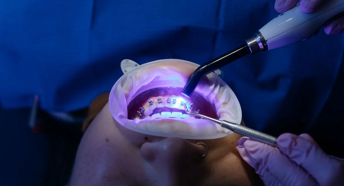UV light curing dental procedure for teeth whitening and health care.