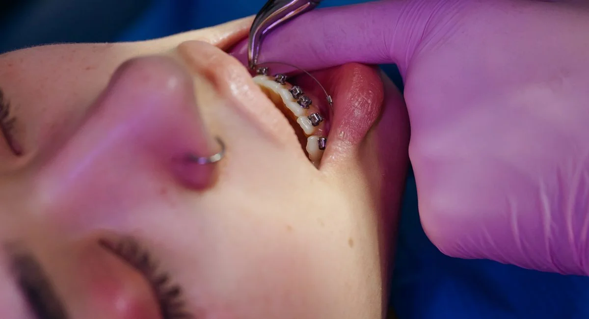 A close-up view of a dental procedure involving braces on a teen.
